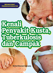 KENALI PENYAKIT KUSTA, TUBERKULOSIS DAN CAMPAK